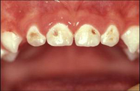 closeup of decay in small child
