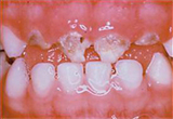 closeup of decay in small child